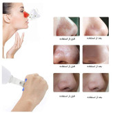 دستگاه میکرودرم شارژی درجه یک با 5 سری
