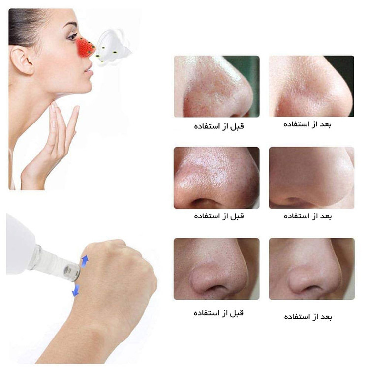 دستگاه میکرودرم شارژی درجه یک با 5 سری